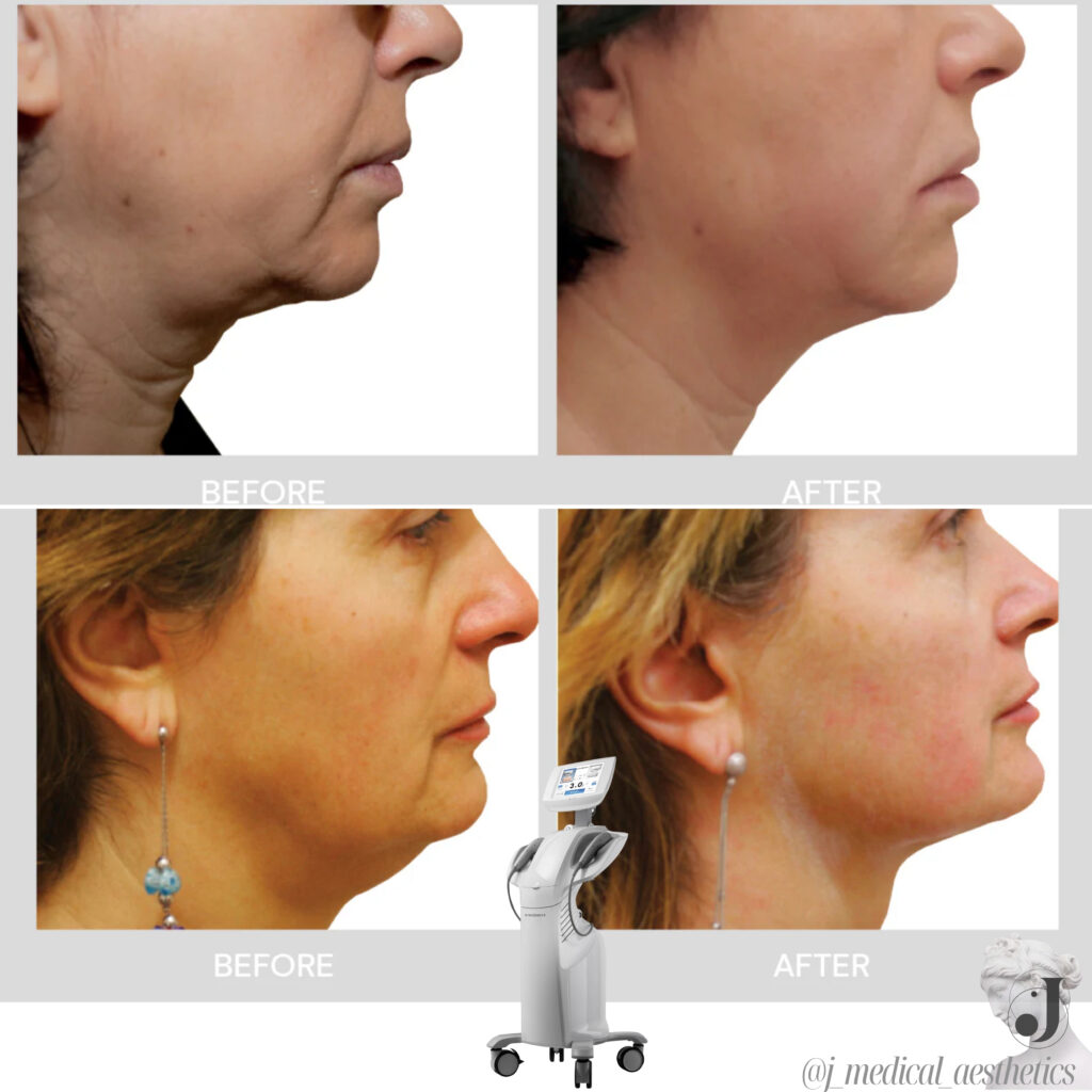 Side by side comparison of neck sagging before and after HIFU treatment showcasing remarkable improvement