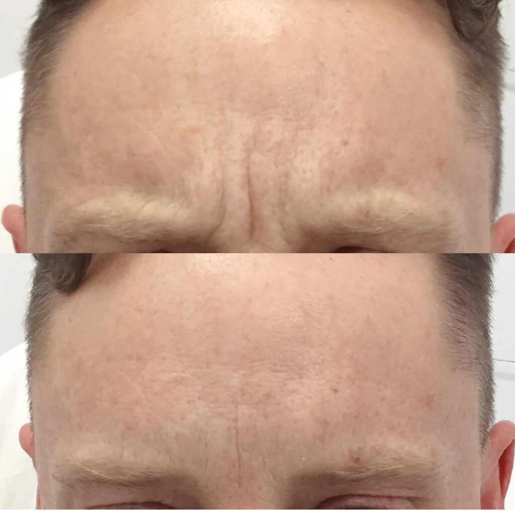 A man showcasing his wrinkles post undergoing our anti wrinkle treatment