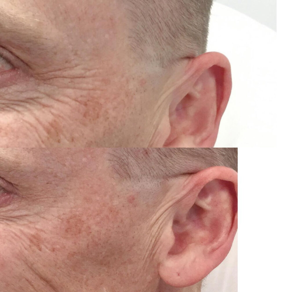 A gentleman presenting his crows feet wrinkles before and after receiving our anti wrinkle treatments