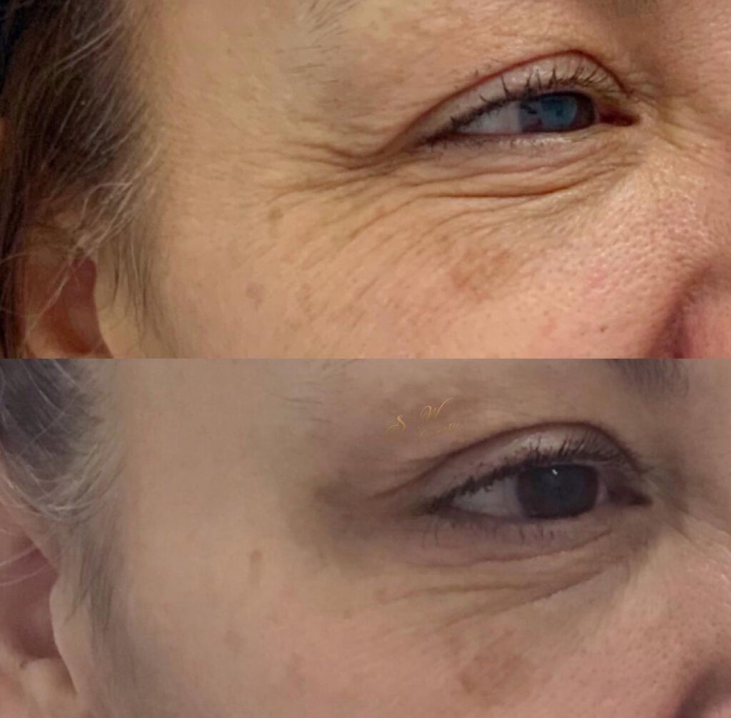 A woman displaying her crows feet wrinkles before and after undergoing our anti wrinkle treatments