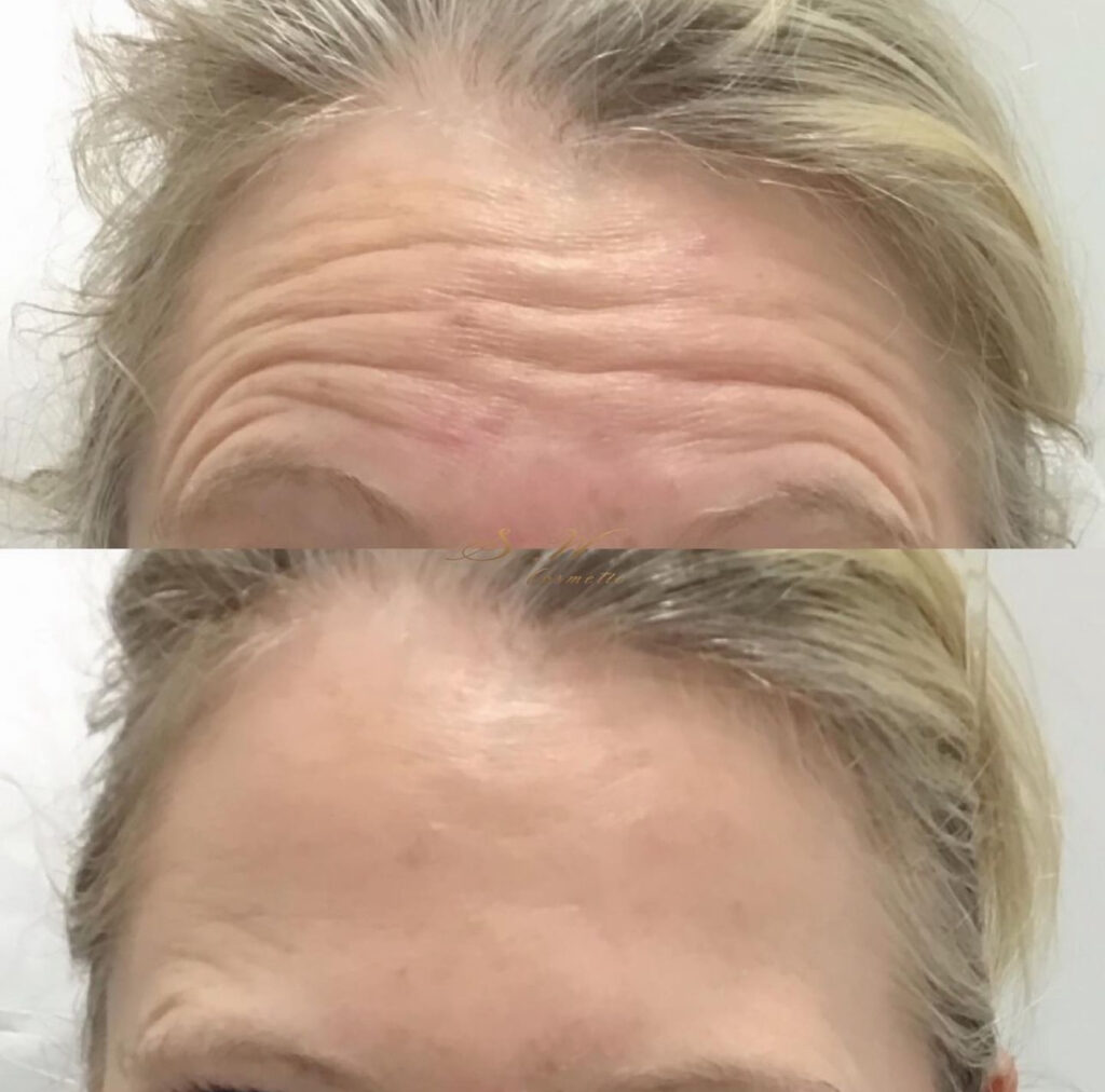 A woman demonstrating her forehead lines before and after receiving our treatment