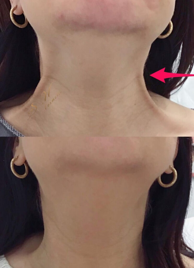 A woman showcasing her neck wrinkles before and after undergoing our treatment