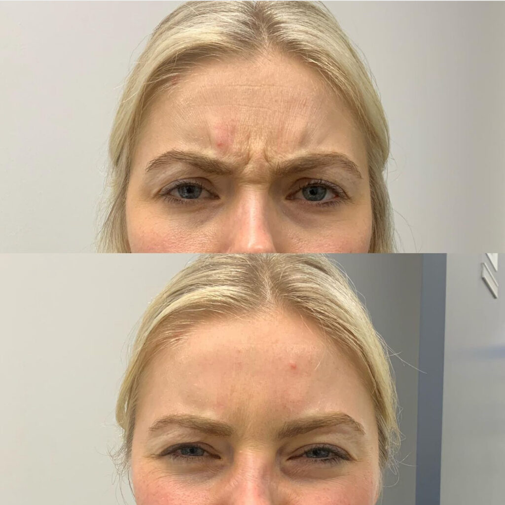 woman showcasing her forehead wrinkles before and after receiving our anti wrinkle treatments