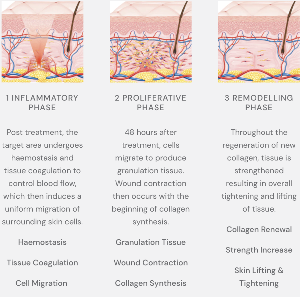 An image illustrating the process of HIFU nonsurgical facelift showcasing its effectiveness and benefits