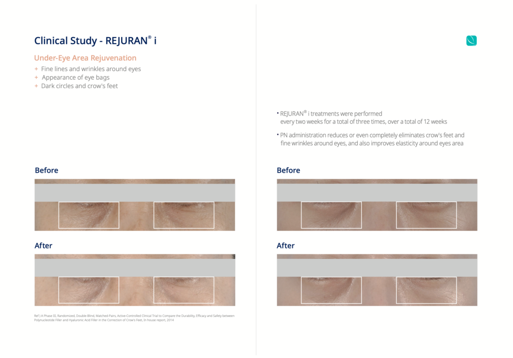 Explore the results of clinical studies highlighting the effectiveness of Rejuran treatment for rejuvenating the under eye area