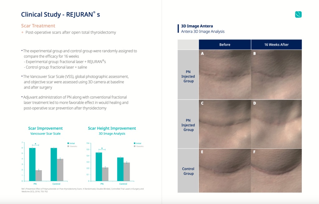 Learn about the findings of clinical studies demonstrating the efficacy of Rejuran treatment for scar reduction