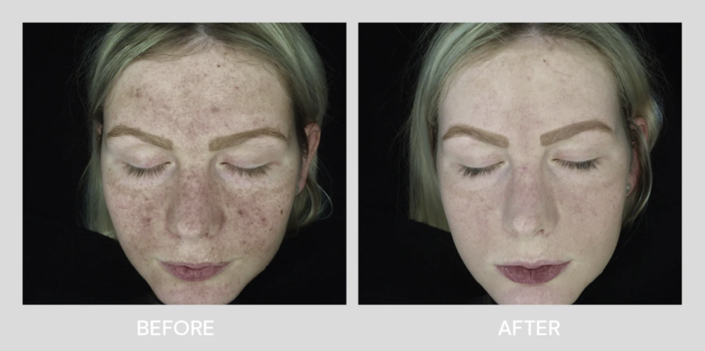 Side by side comparison of a ladys face before and after using RegenPRP showcasing the remarkable transformation in skin texture and appearance