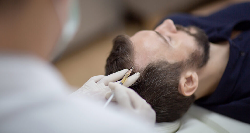 A beautician doctor performing hair mesotherapy and scalp PRP platelet rich plasma injections on a mans head to stimulate hair growth and prevent hair loss and baldness