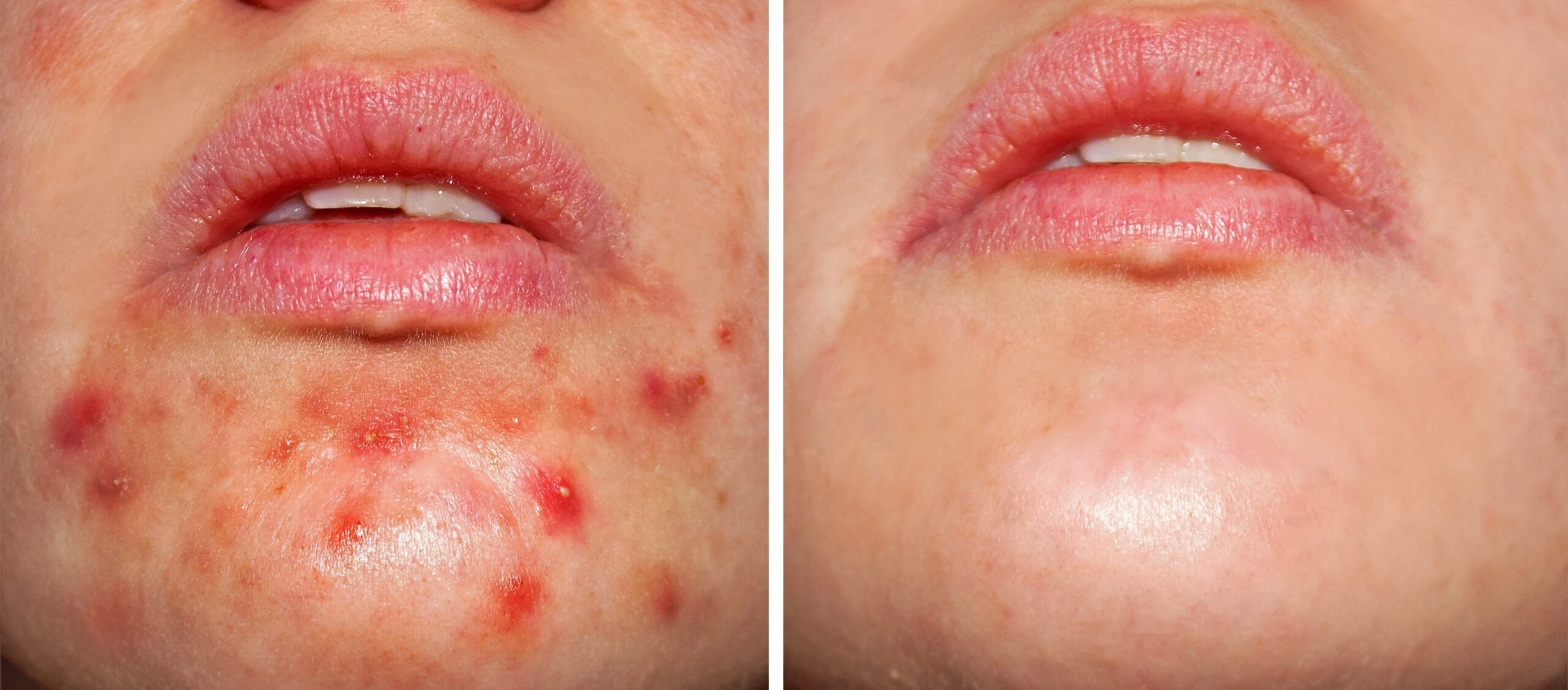 An image showcasing the visible transformation before and after acne treatment revealing clearer and healthier skin