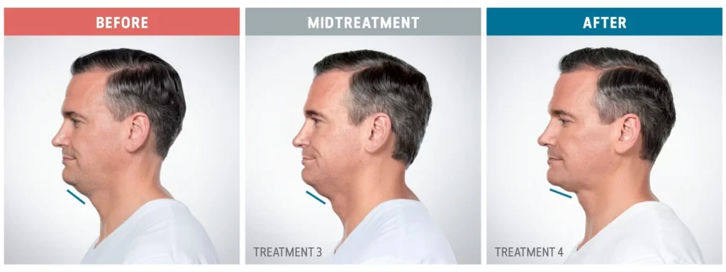 A man showcasing his before and after results of chin fat dissolving injections revealing a noticeable transformation