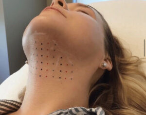 A girl showing her chin during the fat dissolving injection process aimed at contouring and slimming