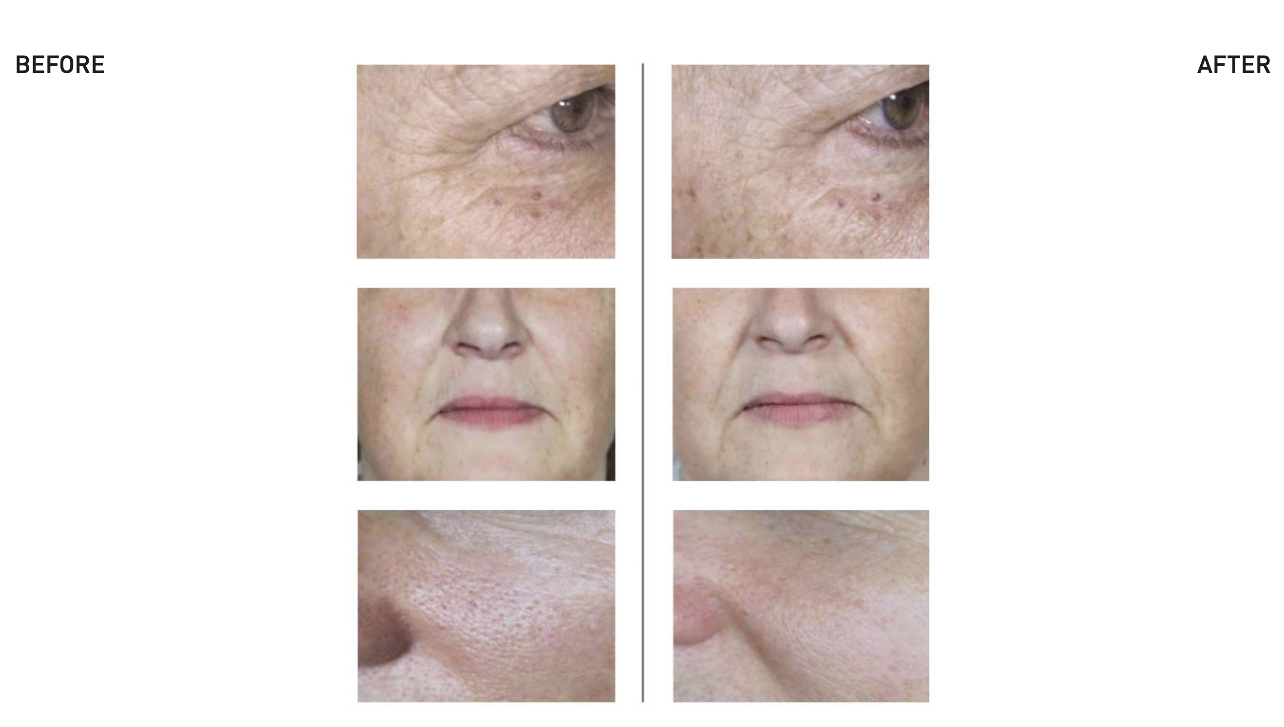 Side by side comparison of a womans skin before and after using Bionutriglow rejuvenation treatment showcasing the remarkable improvement in skin texture and appearance