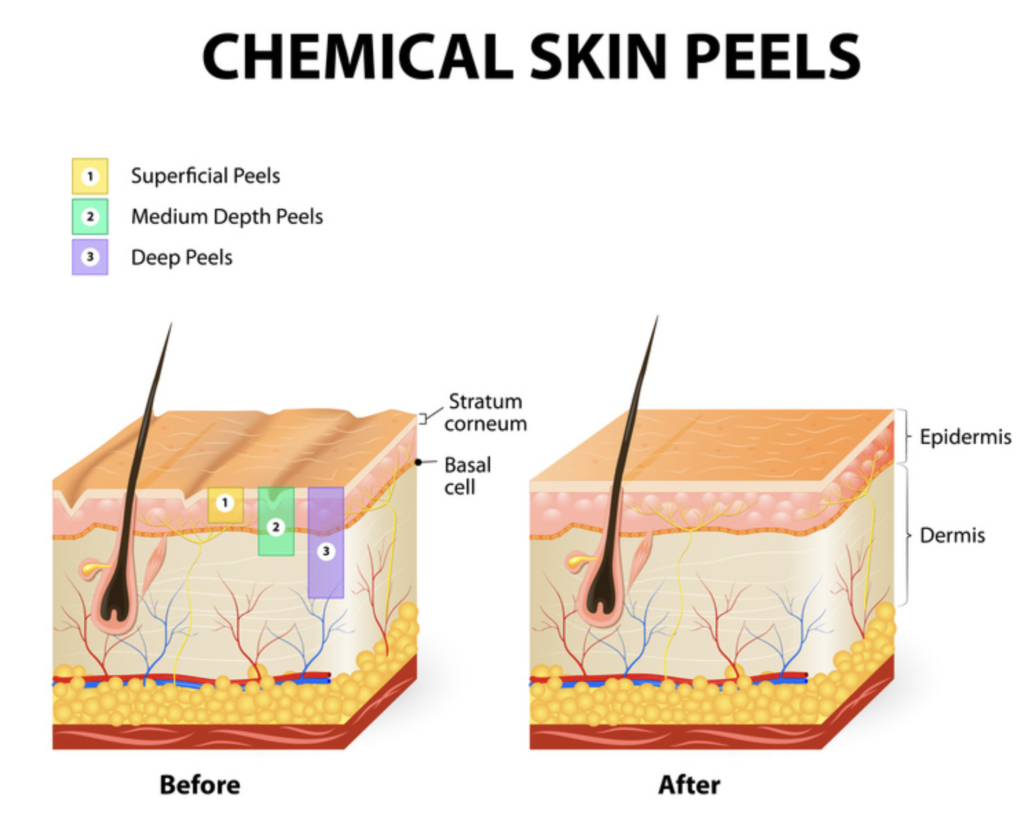 An image showcasing the dramatic before and after results of a chemical skin peel revealing smoother and more radiant skin