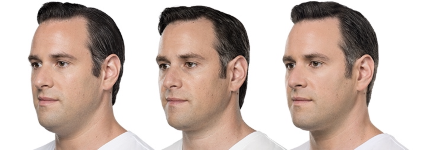 A young man displaying his before and after results of chin fat dissolving injections showcasing a noticeable difference