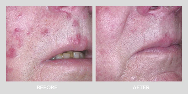 An image showcasing the transformative effects of Healite II LED therapy treatment known for its ability to rejuvenate and revitalize the skin