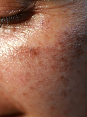 An image depicting pigmentation, a common concern addressed by effective acne treatment for clearer and healthier skin.